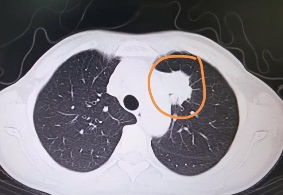 吸烟和肺癌的关系有多大？