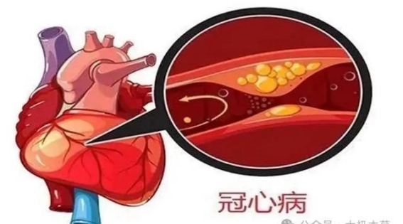 苓桂术甘汤在冠心病治疗中的应用与临床实证