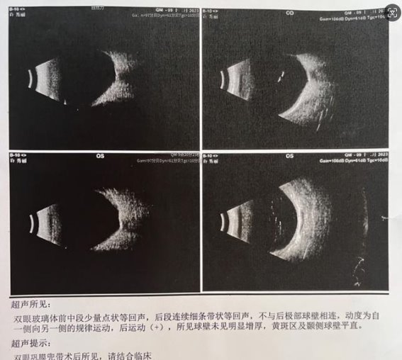 探索现代眼科手术：后巩膜兠带术的革新与选择指南