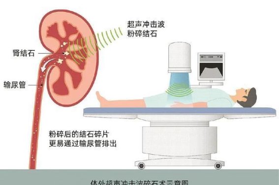 超声波治疗：从碎石到肿瘤，探索医学的新天地