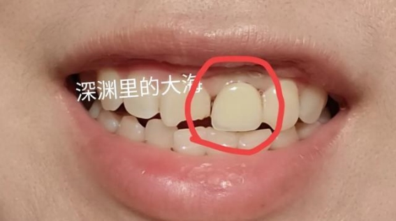 亲身经历告诉你，种植牙“即拔即种”到底好不好？